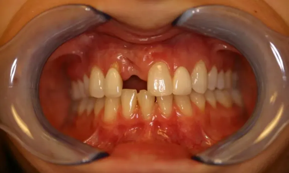 Clinical photo from Hope's smile reconstruction case